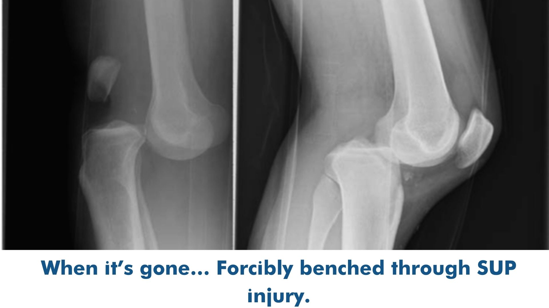 Read more about the article When it’s gone… Forcibly benched through SUP injury.